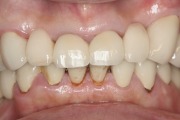 症例2　折れた歯を保護し、守るインプラント