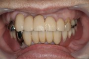 症例4　顎関節症を入れ歯で治す・治療用義歯と片山式K.K.K.装置