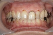 症例1　歯を守る部分入れ歯・片山式K.K.K.装置