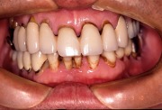 症例3　手直しで長く使おう！部分入れ歯のリフォーム