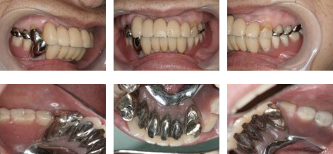 平成19年2月下顎の冠と義歯の同時セット