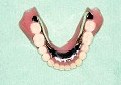 CPデンチャー／無口蓋義歯3