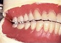 メタルブレードティース使用の無口蓋義歯1