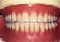 メタルブレードティース使用の無口蓋義歯2