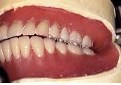 メタルブレードティース使用の無口蓋義歯3