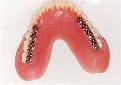メタルブレードティース使用の無口蓋義歯4