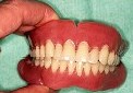 CPデンチャー／無口蓋義歯