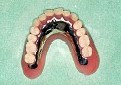 CPデンチャー／無口蓋義歯2