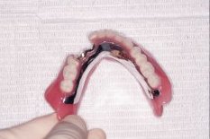 下顎新義歯
