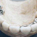 歯のかぶせ物にはどのようなものがあるの？～メリット・デメリット～