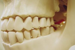 歯を失ってしまったらどうしたらいいの？～ブリッジの適用について～