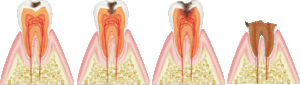 痛い虫歯と痛くない虫歯～虫歯にもステージがある？～