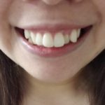 八重歯は気になる？～八重歯が生える原因って？～