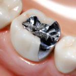 銀歯にはリスクがある？！～銀歯のメリット・デメリット～